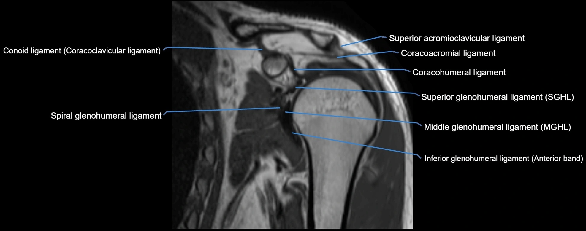 shoulder ligments coronal  cross sectional anatomy 3T MRI AI enhanced radiology image -img-00001-00018.webp